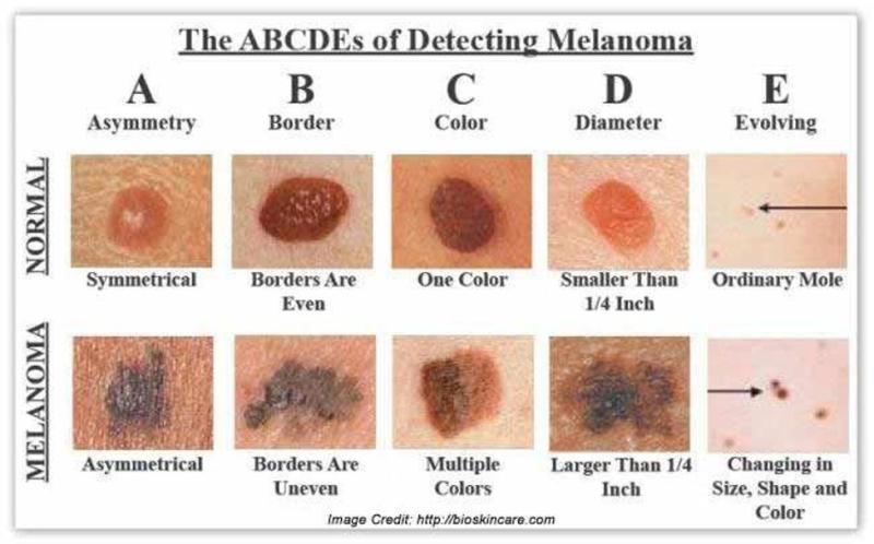 chart of detecting moles